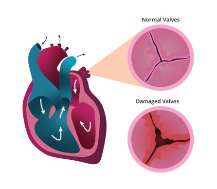 Graphic of a heart - normal valve shows the edges seal where the damaged valve has openings.