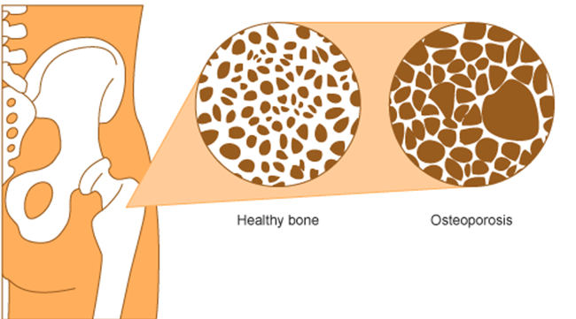 This diagram compares healthy bone with bone affected by osteoporosis. It shows reduced bone density in the bone affected by osteoporosis compared with healthy bone.