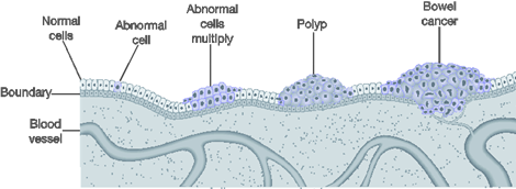 This pictorial representation shows the progression from normal cell, to abnormal cell, to polyp, to bowel cancer.